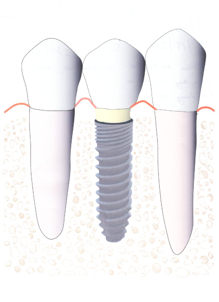 IMPLANT NHA KHOA